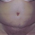 Tummy Tuck Before & After Patient #4850