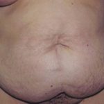 Tummy Tuck Before & After Patient #4850