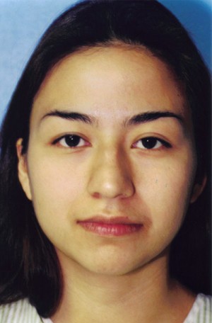 Rhinoplasty Before & After Patient #4777