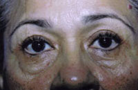 Facelift / Blepharoplasty Before & After Patient #4740