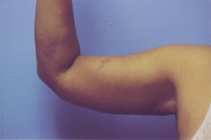 Brachioplasty Before & After Patient #4828