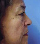 Facelift / Blepharoplasty Before & After Patient #4740