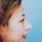 Rhinoplasty Before & After Patient #4786