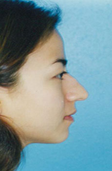 Rhinoplasty Before & After Patient #4786