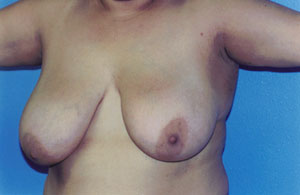 Breast Lift Before & After Patient #5007