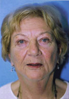 Facelift / Blepharoplasty Before & After Patient #4750