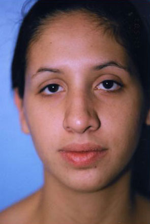 Rhinoplasty Before & After Patient #4789