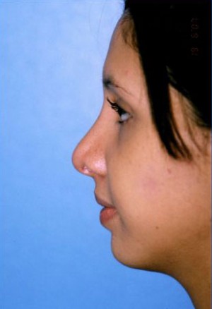 Rhinoplasty Before & After Patient #4789