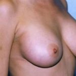 Breast Augmentation Before & After Patient #4916