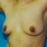 Breast Augmentation Before & After Patient #4927