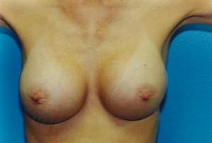 Breast Augmentation Before & After Patient #4934