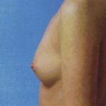 Breast Augmentation Before & After Patient #4941