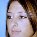 Rhinoplasty Before & After Patient #4812