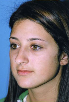 Rhinoplasty Before & After Patient #4812