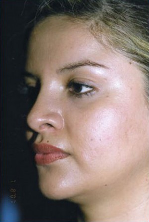 Rhinoplasty Before & After Patient #4821