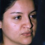 Rhinoplasty Before & After Patient #4821