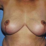 Breast Lift Before & After Patient #5047