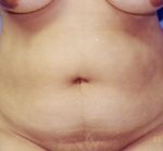 Tummy Tuck Before & After Patient #4889