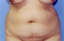 Tummy Tuck Before & After Patient #4889