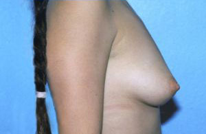 Breast Augmentation Before & After Patient #4953