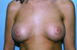 Breast Augmentation Before & After Patient #4962