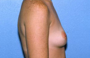 Breast Augmentation Before & After Patient #4976