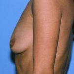 Breast Augmentation Before & After Patient #4988