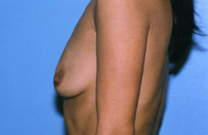 Breast Augmentation Before & After Patient #4988