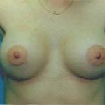 Breast Augmentation Before & After Patient #4993
