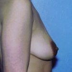 Breast Augmentation Before & After Patient #5000
